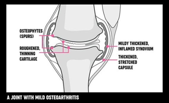 mild_osteoarthritis