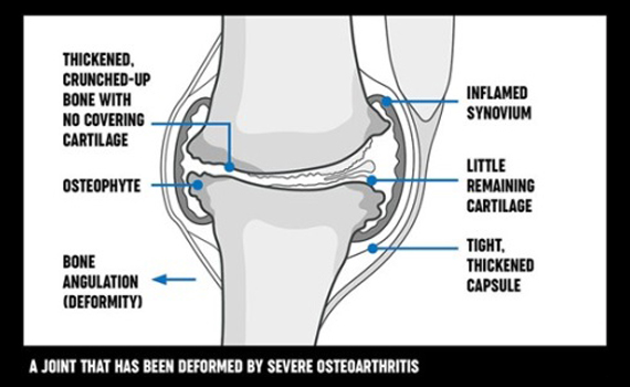 severe_osteoarthritis